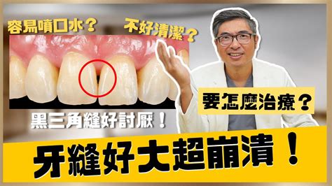 門牙中間黑黑的|健康網》齒間出現「黑三角縫」怎麼辦？ 補救、預防1次看